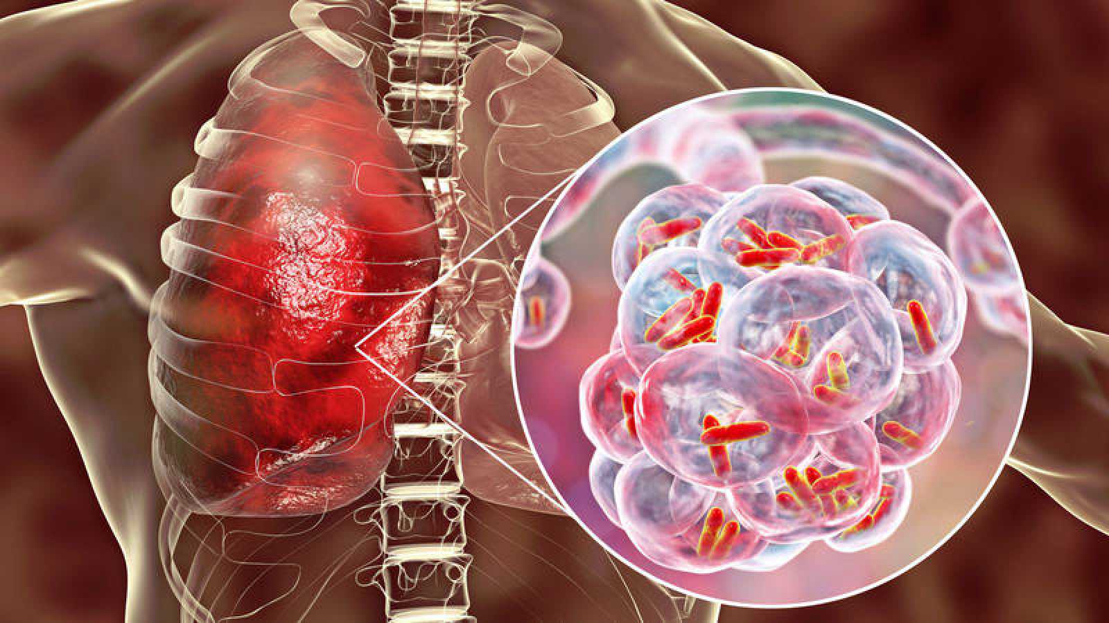 La Tuberculosis aumenta en los Estados Unidos.